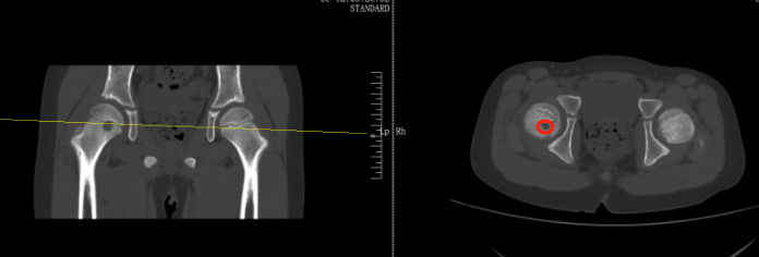 那可恩普拉托姆联vs查英特贺纳比尔_13岁女孩频繁屁股疼确诊骨癌那可恩普拉托姆联vs查英特贺纳比尔！或将截掉一侧屁股