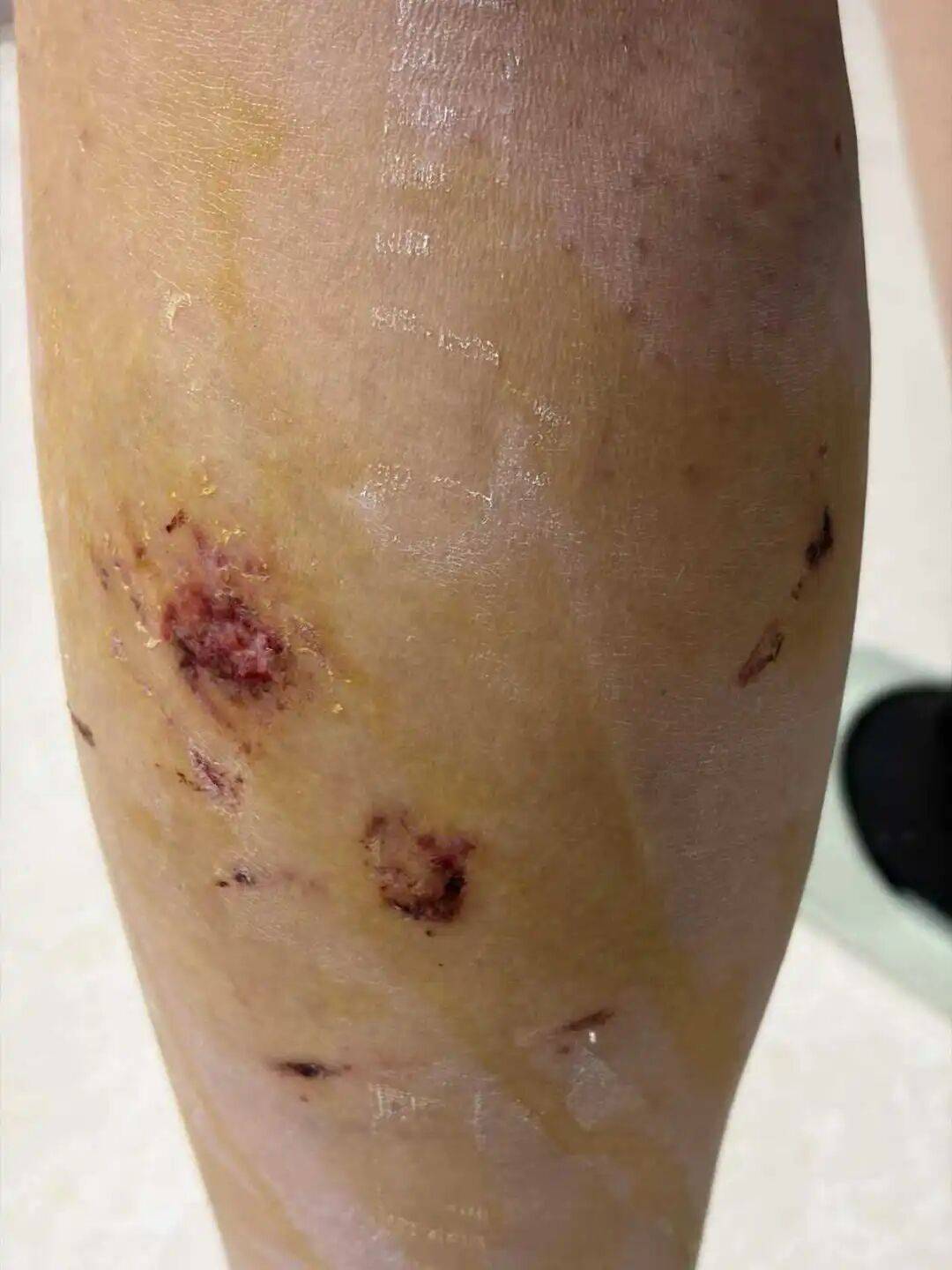 皇冠信用网会员账号_河南一女大学生遭校园内群狗围攻咬伤皇冠信用网会员账号，幸亏有同学骑电动车撞开狗群而获救，流浪狗至今仍在校园，校方称将联系保卫处处理