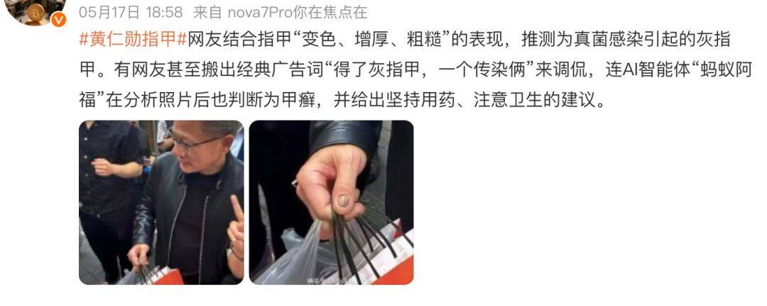 TianLu V BOA_黄仁勋的指甲冲上热搜！高清镜头曝光TianLu V BOA，网友吵翻！医生：这6种情况都可能